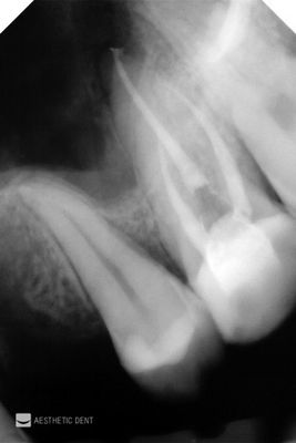 Ząb po leczeniu kanałowym, z odbudową protetyczną. RTG zęba.